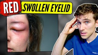 Swollen Eyelid causes amp solutions  Eye Doctor Explains [upl. by Yvonne932]