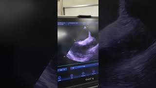 Echocardiography finding of elderly patient with asdpfo [upl. by Delija]