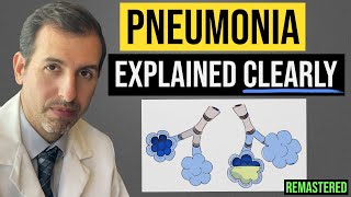 Pneumonia Explained Symptoms Diagnosis Labs Treatment [upl. by Smitty434]