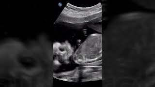 Fetal ultrasound anatomy medicalimaging radiographictestingmedicaltest medicalanimation [upl. by Quennie]