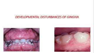 DEVELOPMENTAL DISTURBANCES OF GINGIVA [upl. by Ingram613]