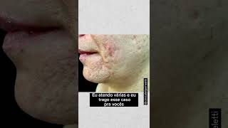 Cicatriz de Acne [upl. by Cerf]