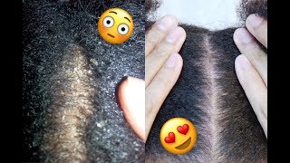 How I Cured My EXTREMELY Dry Scalp [upl. by Feerahs]