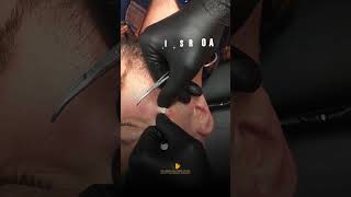 Epidermoid cyst removal [upl. by Ahseal]