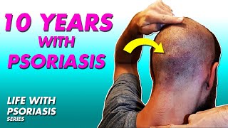 Shaving My Head After 10 Years Of Psoriasis  Life With Psoriasis [upl. by Enellek]