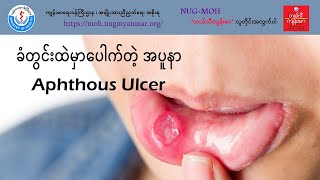 ခံတွင်းထဲမှာပေါက်တဲ့အပူနာ Aphthous Ulcer [upl. by Doralynn]