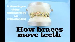 How braces move teeth timelapse  Braces Explained [upl. by Eneiluj]