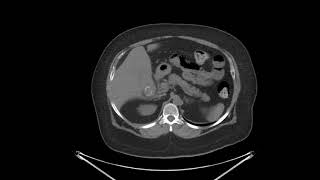 Acute cholecystitis with tensile fundus sign [upl. by Wanyen426]