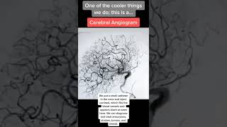 Amazingly beautiful brain angiogram imaging [upl. by Evreh]