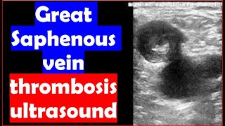 Great Saphenous vein thrombosis Ultrasound [upl. by Naggem463]