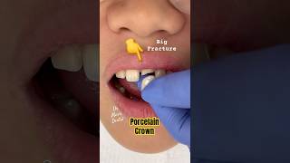 Porcelain Crown on broken front tooth [upl. by Pry]