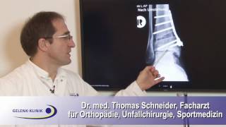 Stellungskorrektur Osteotomie des Sprunggelenks [upl. by Novets909]