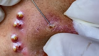 Big Cystic Acne Blackheads Extraction Blackheads amp Milia Whiteheads Removal Pimple Popping [upl. by Carnahan452]