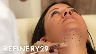 Kybella Double Chin Removal Treatment Up Close  Macro Beauty  Refinery29 [upl. by Aholah663]