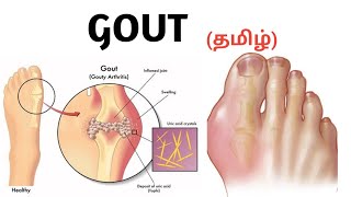 Gout  Causes  Symptoms  Risk factors  Treatment  தமிழ் [upl. by Ettenil295]