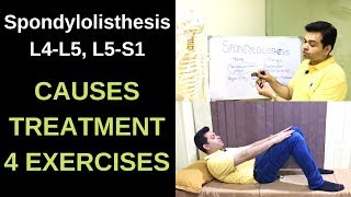 Spondylolisthesis L4L5 L5S1 Spondylolysis Spondylolisthesis Treatment Exercises LOW BACK PAIN [upl. by Enyalaj505]