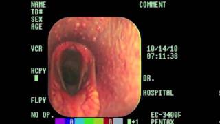 Laryngeal Hemiplegia Explained m4v [upl. by Shelby]