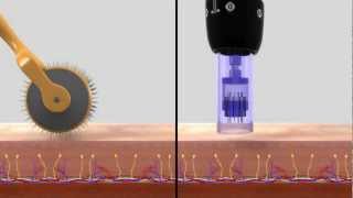 DERMAPEN SISTEMA DE REMODELACIÓN TISULAR [upl. by Bathsheb]