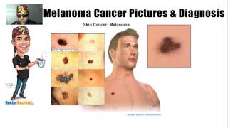 Spotting Melanoma Cancer and Symptoms with Pictures [upl. by Eatnad]