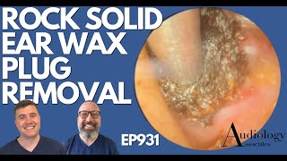 ROCK SOLID EAR WAX PLUG REMOVAL  EP931 [upl. by Irihs]