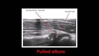 PEM POCUS UK  Visualising the real time reduction of pulled elbow using POCUS [upl. by Adahs539]