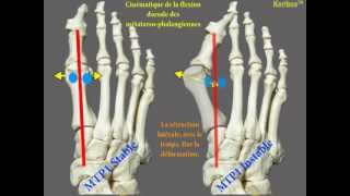 Instabilité de la première métatarsophalangienne dans lhallux valgus [upl. by Brunhilde]