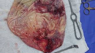 laparoscopic cystectomy by prof DR Soliman Elshakhs [upl. by Demb]