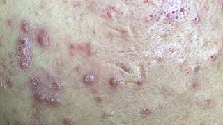 AWESOME INFLAMED BLACKHEADS FIELD  Full Treatment  46m 30s [upl. by Ynnohj583]