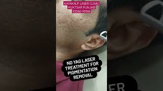 Nd Yag Laser Treatment for Pigmentation Treatment scartreatment pigmentation [upl. by Hanavas]