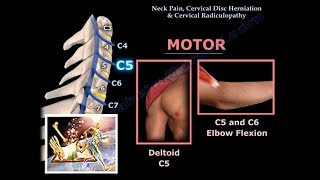 Neck Pain Cervical Disc Herniation amp RadiculopathyEverything You Need To Know  Dr Nabil Ebraheim [upl. by Yrret543]