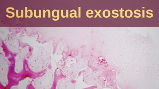 What is a Subungual Exostosis  pathology mini tutorial [upl. by Gottuard]