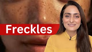 Freckles  causes  treatment  recommendations  Dermatologist [upl. by Mcdade163]