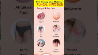 R82 Drops for Fungal Infectiondr reckeweg r82 in hindir82 antifungalmedicine shorts [upl. by Ibbison]