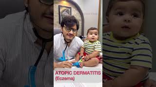 Atopic dermatitis drimranpatel baby shorts doctor [upl. by Ahsiaa]