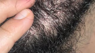 INGROWN HAIRS REMOVED ASMR CATTING BIG PROBLEM REMOVED  INGROWN 10 INGROWN SATISFYING [upl. by Wanyen]