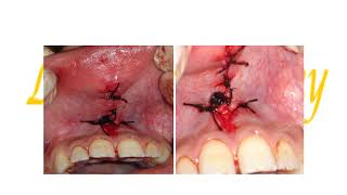 Preprosthetic sugery Soft tissues procedures [upl. by Stroud]