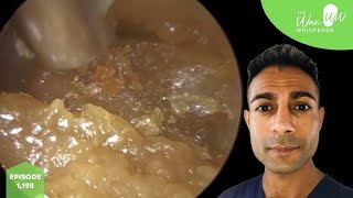 1198  Blocked Ear Wax Removal with Benign Osteoma [upl. by Paza996]