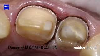 Less Invasive Veneer Preparation with Magnification Enhancing Your Smile [upl. by Leunamme]