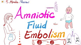 Amniotic Fluid Embolism  ObGyn Pathology Lectures  5MinuteReview Series [upl. by Earleen609]