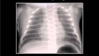 LearningRadiology 18 Neonatal Lung Disease [upl. by Chemash308]