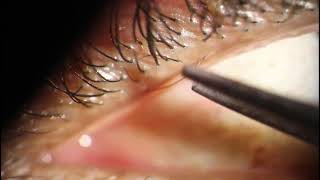 Trichiasis Epilation  TWO eyelashes out of ONE meibomian gland [upl. by Annabel]