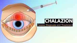 CHALAZION Causes Signs and Symptoms Diagnosis and Treatment [upl. by Darrick]