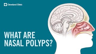 What Are Nasal Polyps [upl. by Harlan]