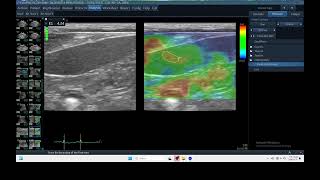 IQ 311 SPLEEN ELASTOGRAPHY ULTRASOUND HC MENINGIOMA ECHOPAC ANALYSIS [upl. by Aiem]