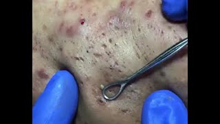 More Craters  More Blackheads WATCH THESE PIMPLES Originial ASMR [upl. by Ayet]