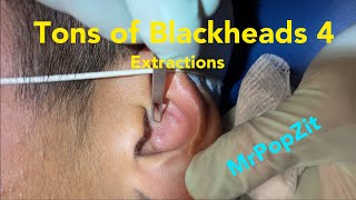 Tons of blackheads 4 Acne extractions Blackheads whiteheads milia Nose ears lips Pore dirt [upl. by Naloc812]