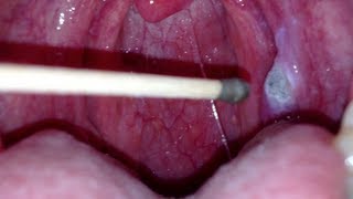 silver nitrate burning of a canker sore [upl. by Notxed]