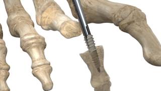 Stryker ToeTac  Implant for Hammertoe Fixation  Animation [upl. by Forras]