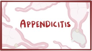 Appendicitis  causes symptoms diagnosis treatment amp pathology [upl. by Ardnuek]