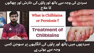 Sardi ma Ungaliyon ki Soojan aur Khaarish ka Illaj  Causes and Treatment of Chilblains  Perniosis [upl. by Aem753]